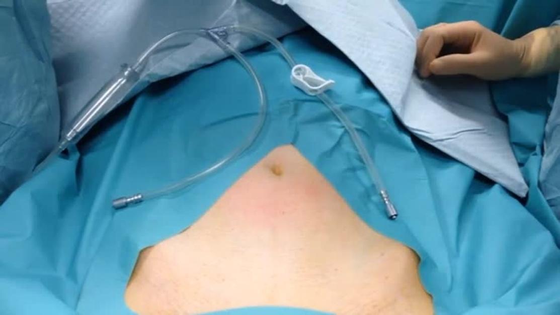 Laparoscopic Sacrocolpopexy Surgery in Pune – Advanced Prolapse Treatment